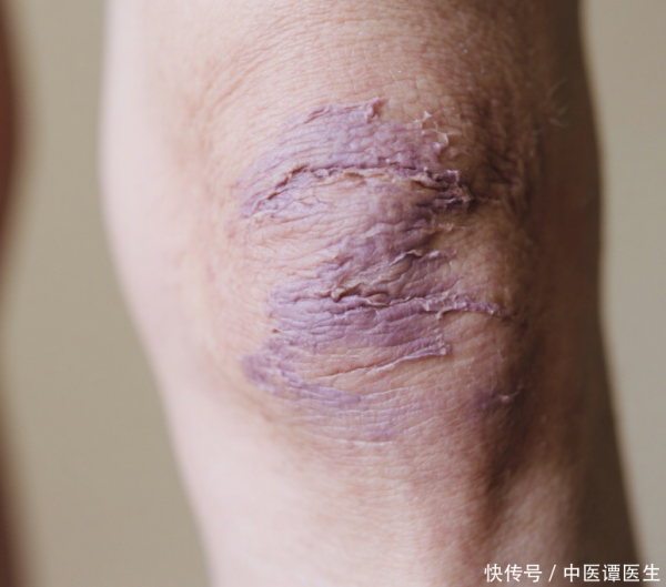 旺润配资 身体不明瘀紫？中医提示或气滞血瘀，科学排查调理更护健康